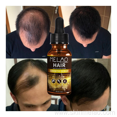 Anti Hair Loss Boosting Hair Growth Serum